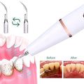 Advanced Electric Teeth Cleaning Tool Powerful Calculus Remover & Tartar Eraser