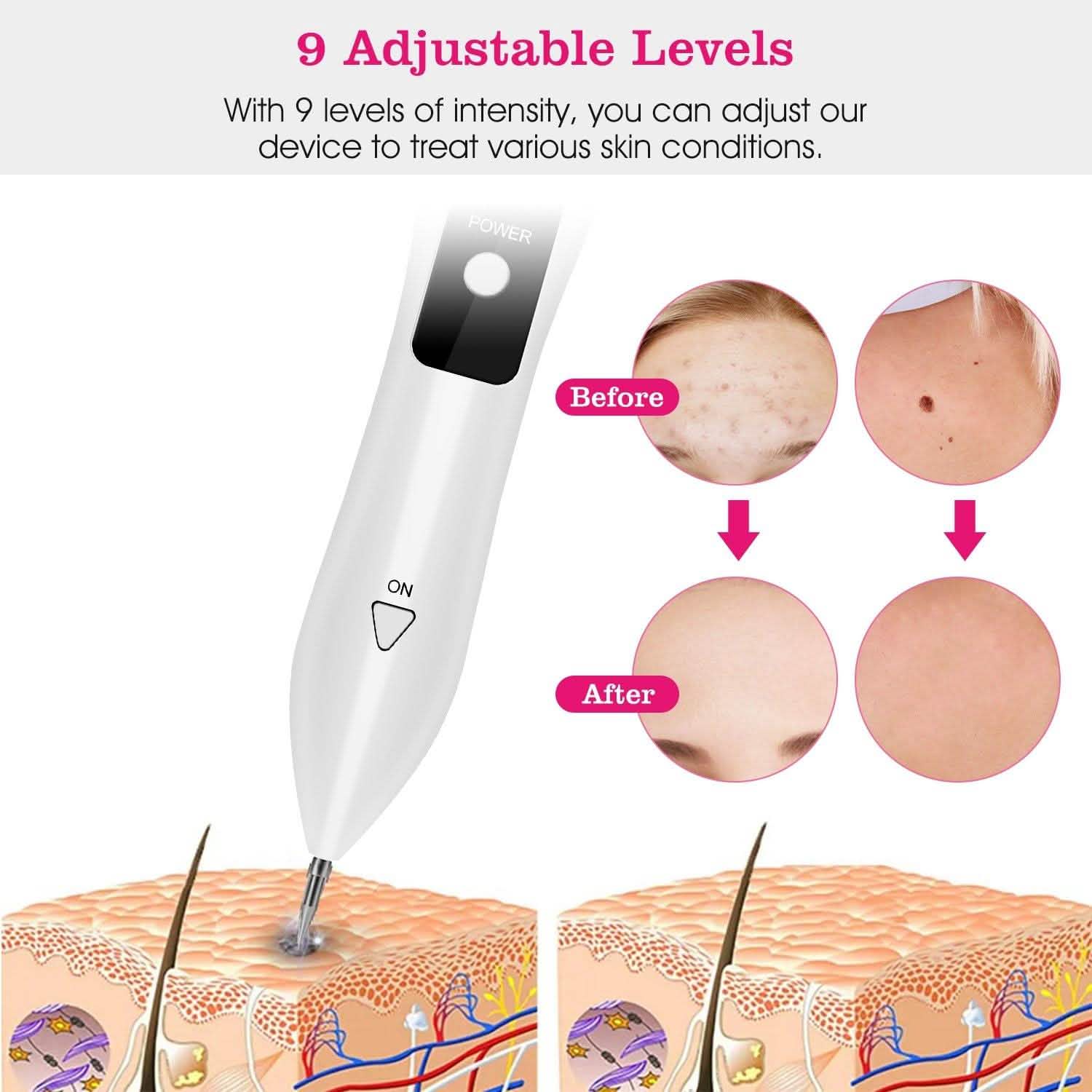 Portable Skin Tag Repair Kit with 6 Replaceable Needles